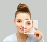 מתיחת פנים באמצעות חוטים-תמונה